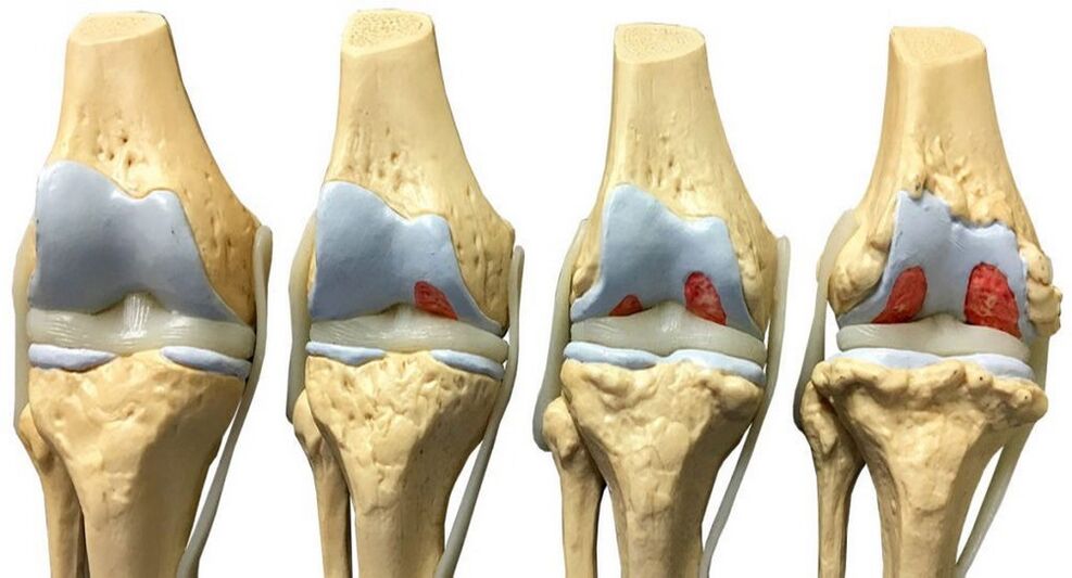 L'arthrose peut être traitée avec Hondrofrost