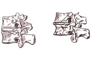 Stades de développement de la thoraxostéochondose