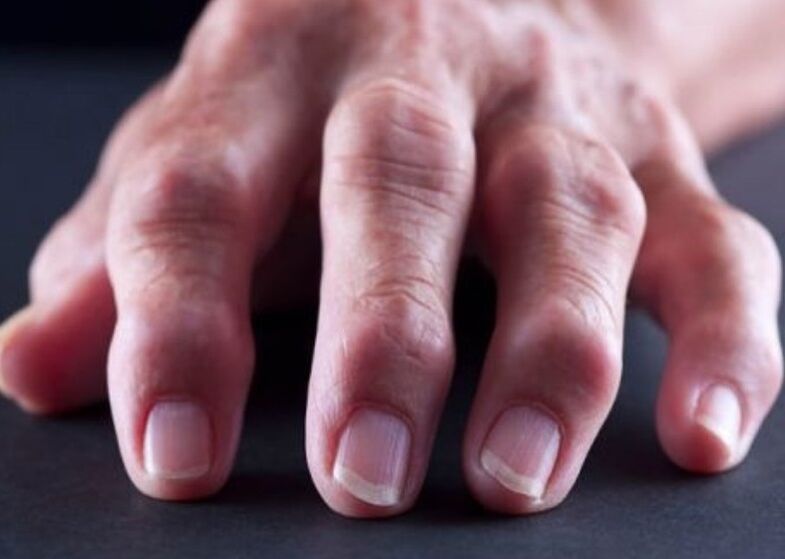 la polyarthrite rhumatoïde comme cause de douleurs dans les articulations des doigts